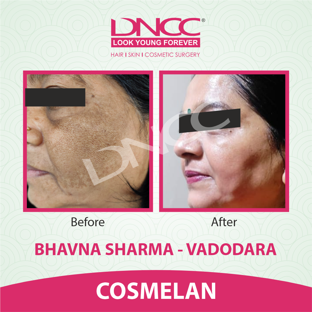 Hair Transplant Transformation 1